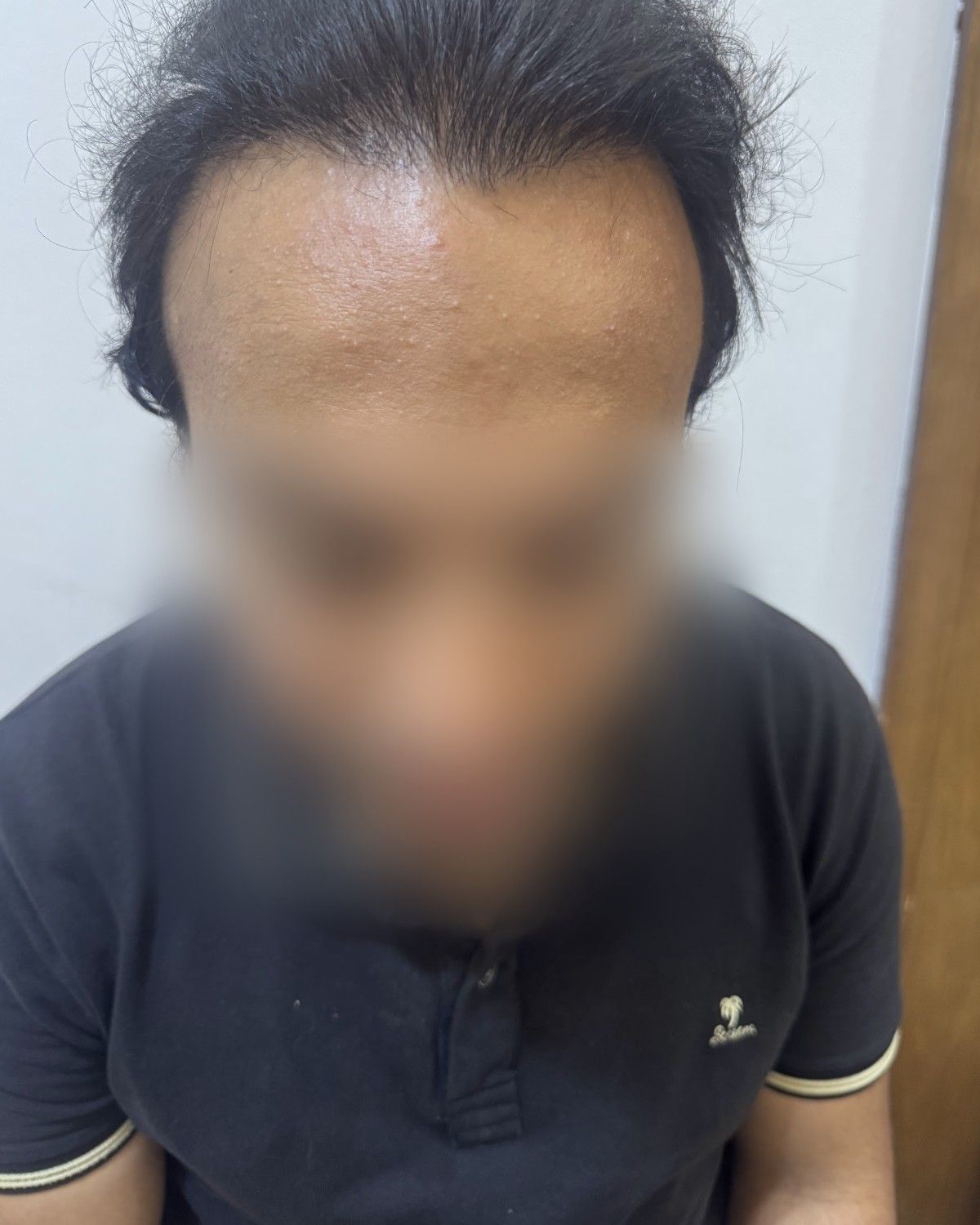 طبيب تخدير يستعيد المنطقة العلوية – بعد الزراعة (أمامي)