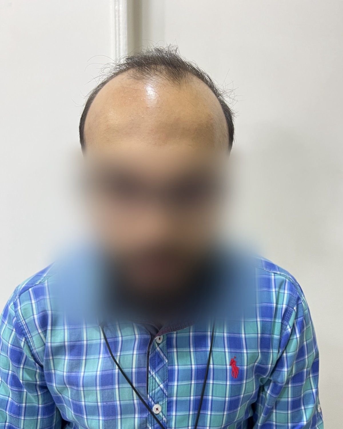 طبيب تخدير يستعيد المنطقة العلوية – قبل الزراعة (أمامي)