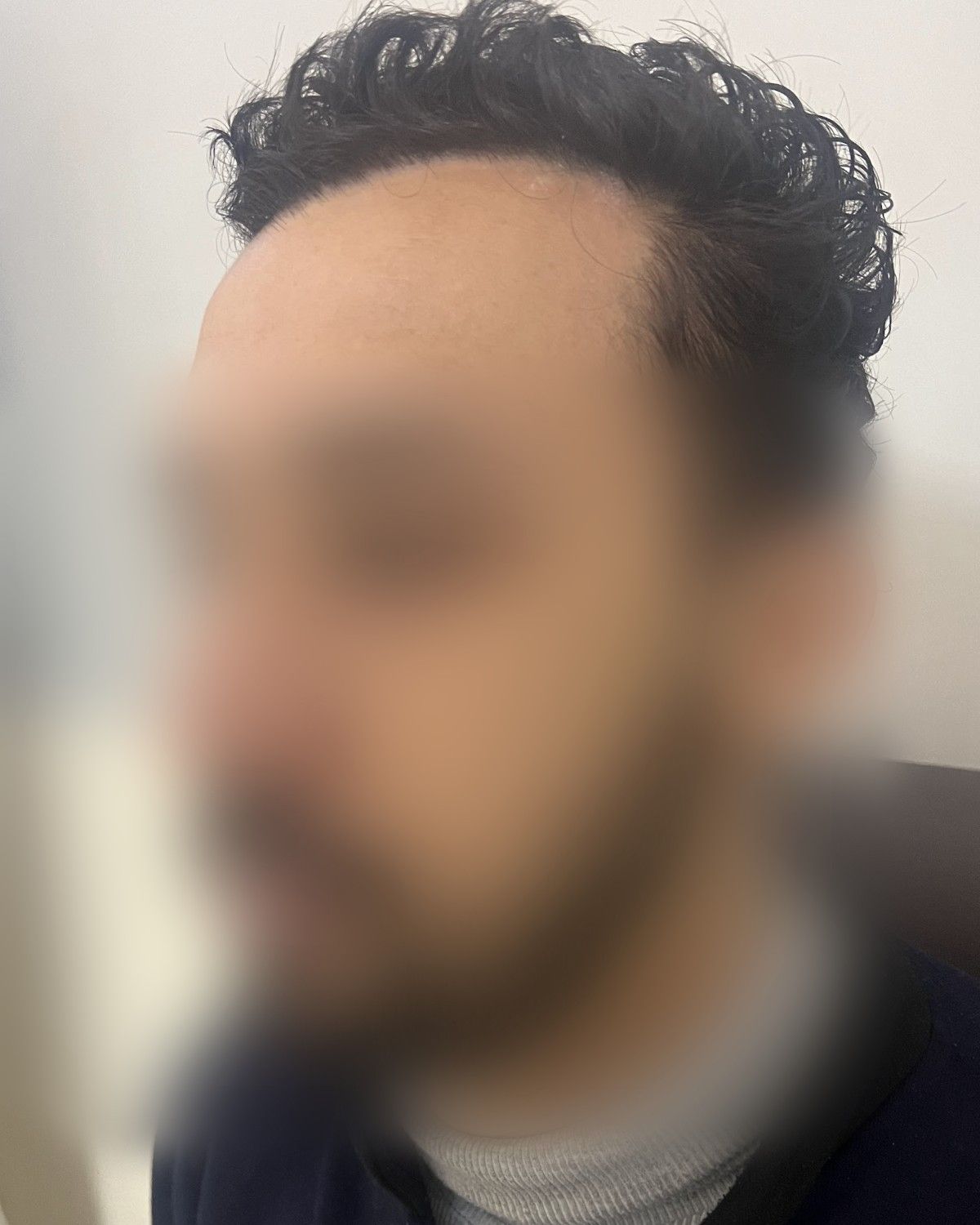 زراعة في منطقة ندبة – بعد الزراعة (جانبي)