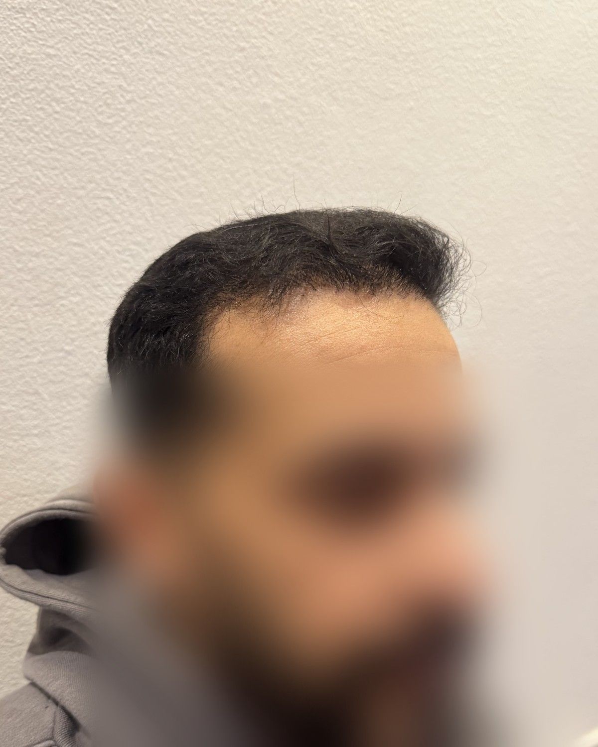 مريض من السعودية – بعد الزراعة (جانبي)