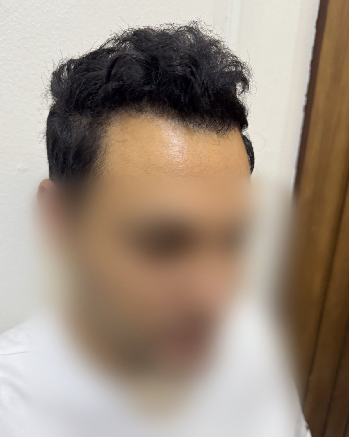 كثافة كاملة لمريض من العريش – بعد الزراعة (جانبي)
