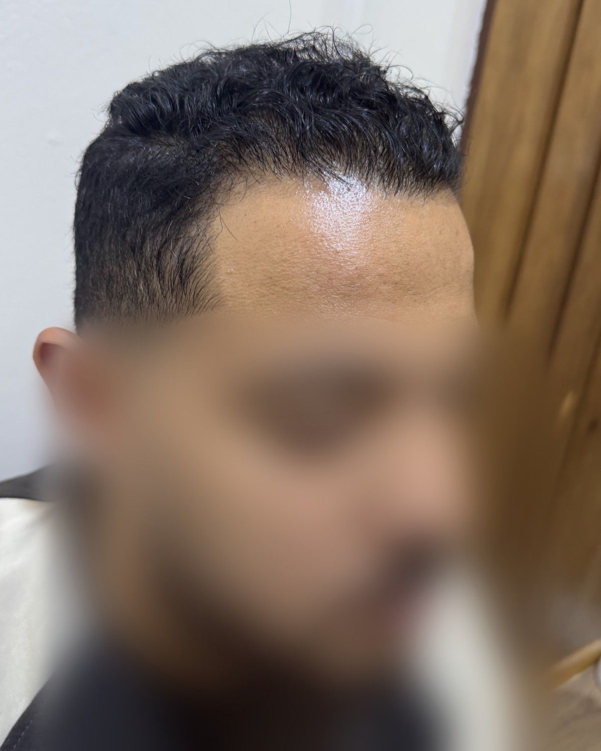 خط شعر أمامي طبيعي – بعد الزراعة (جانبي)