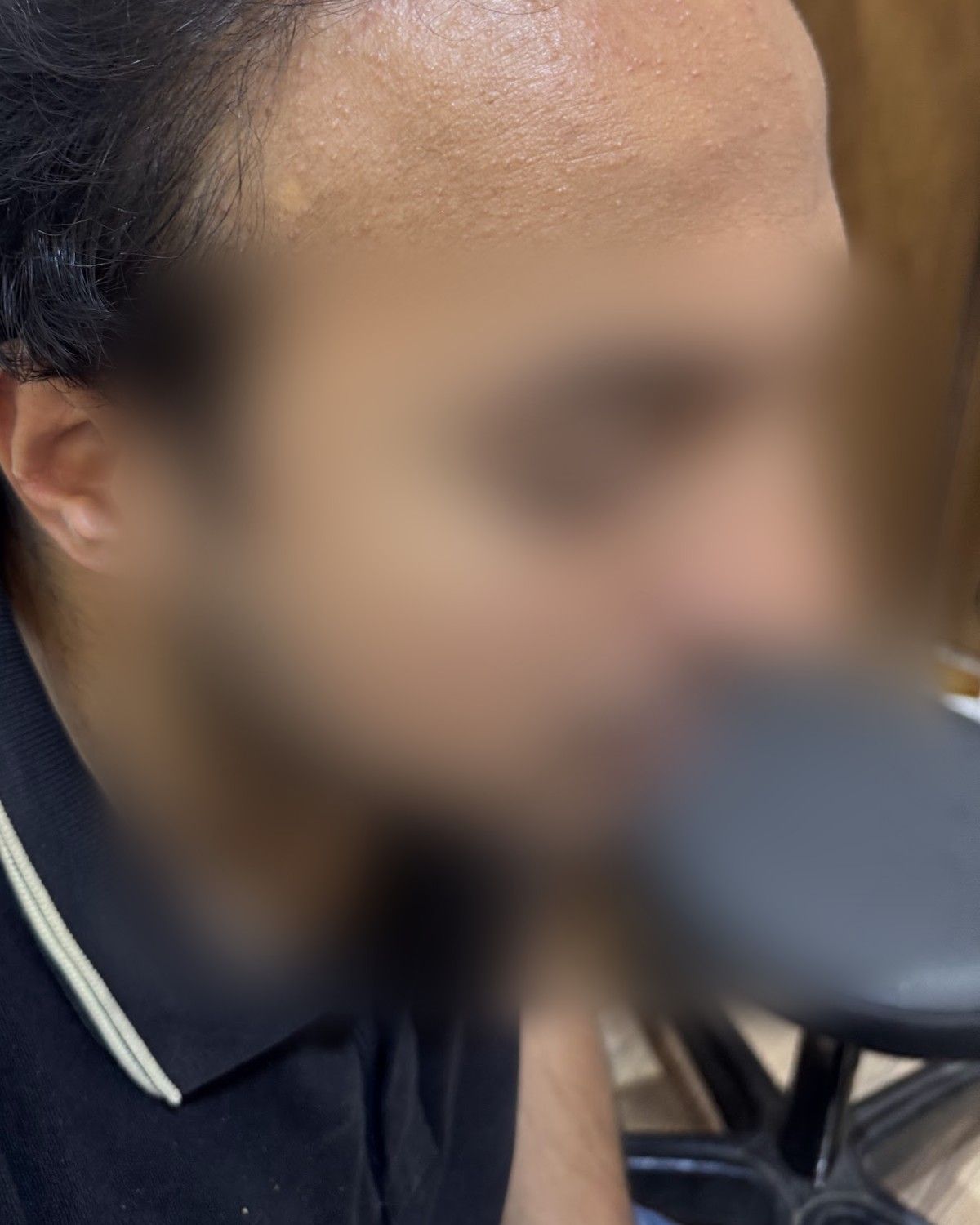 طبيب تخدير يستعيد المنطقة العلوية – بعد الزراعة (جانبي)