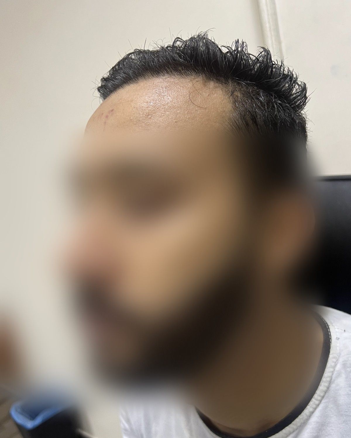 زراعة في منطقة ندبة – قبل الزراعة (جانبي)