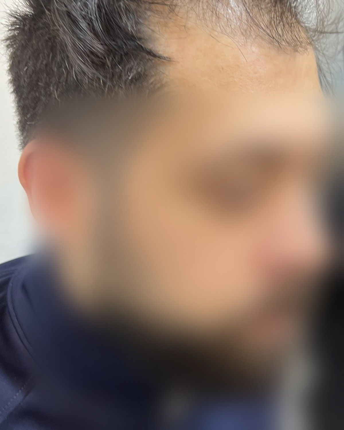 خط شعر وكثافة لمريض من العريش – قبل الزراعة (جانبي)