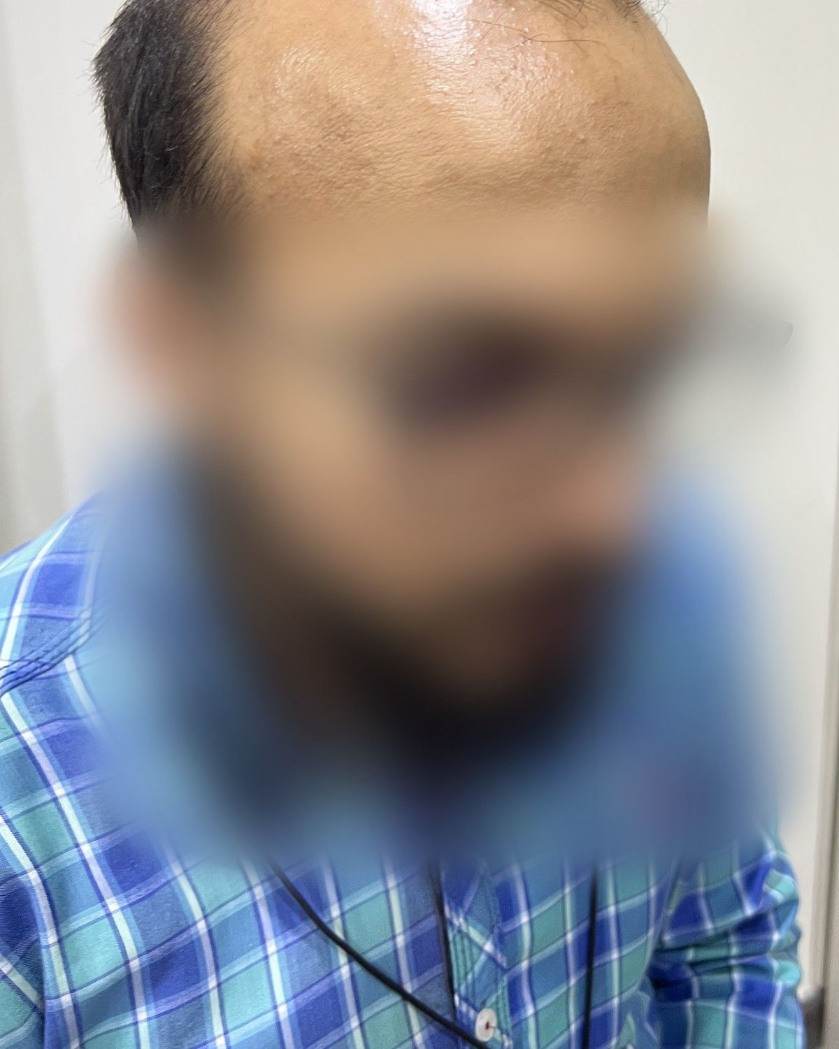 طبيب تخدير يستعيد المنطقة العلوية – قبل الزراعة (جانبي)