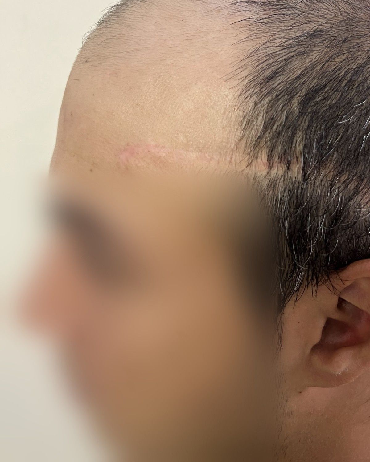 زراعة بالزاوية الصفرية – قبل الزراعة (جانبي)