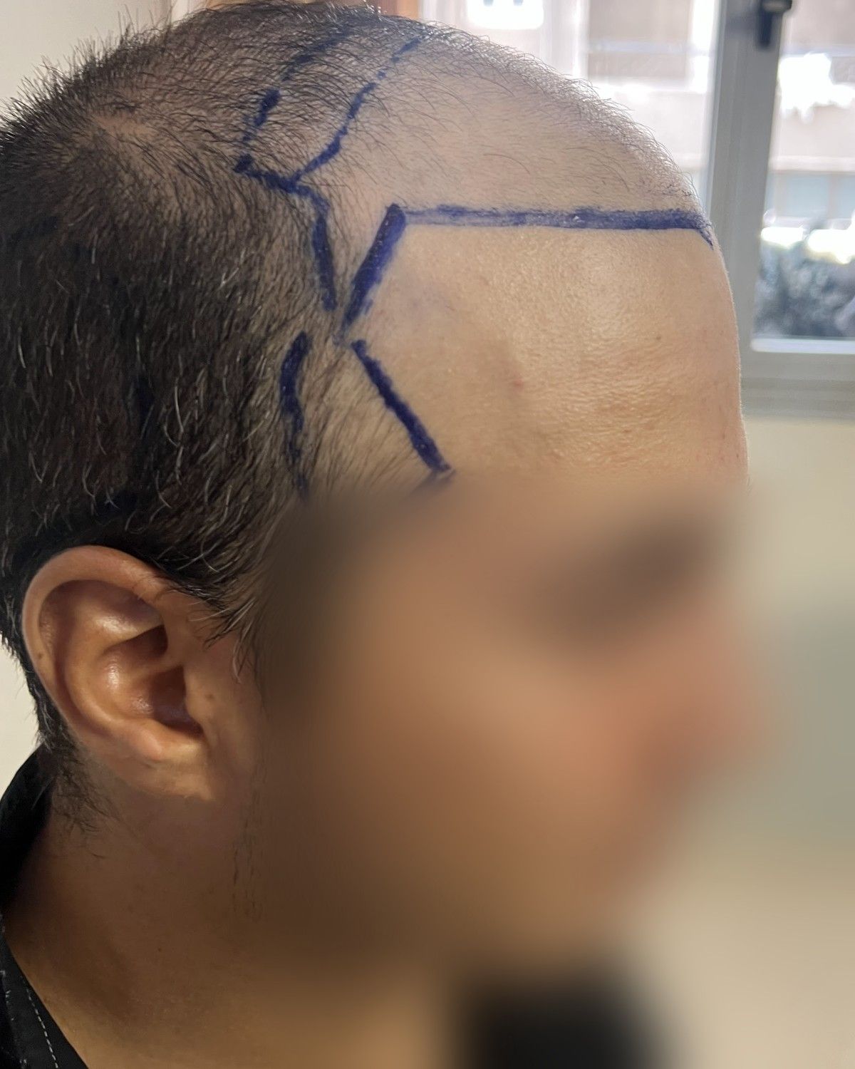 زراعة بالزاوية الصفرية – قبل الزراعة (الجانب الآخر)