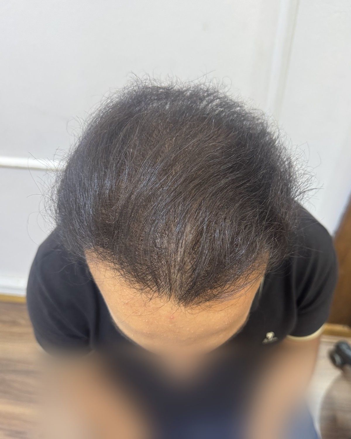 طبيب تخدير يستعيد المنطقة العلوية – بعد الزراعة (من أعلى)