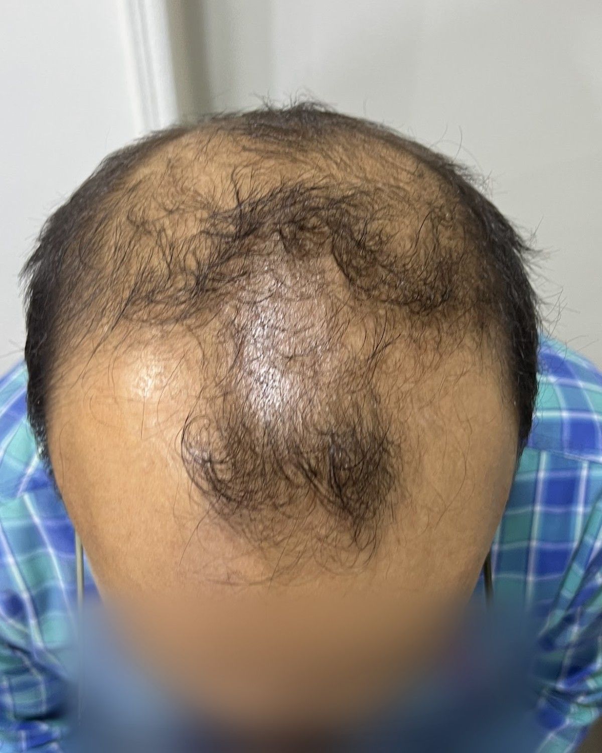 طبيب تخدير يستعيد المنطقة العلوية – قبل الزراعة (من أعلى)